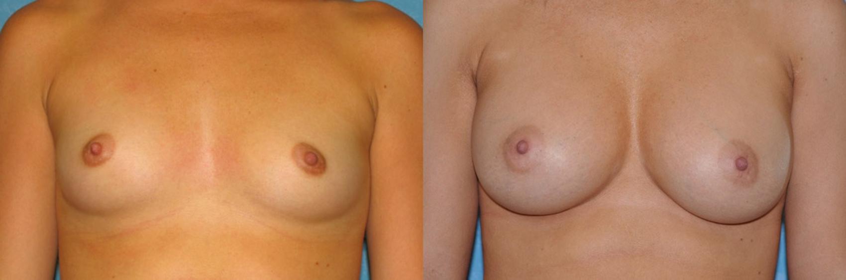 Breast Augmentation Before & After Photo | Toledo, Ohio | Dr. Craig Colville