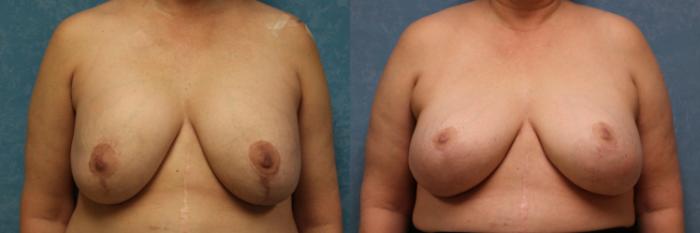 Before & After Breast Lift With Implants Case 555 Front View in Toledo, Ohio