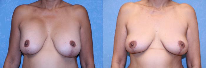 Before & After Breast Lift Case 569 Front View in Toledo, Ohio