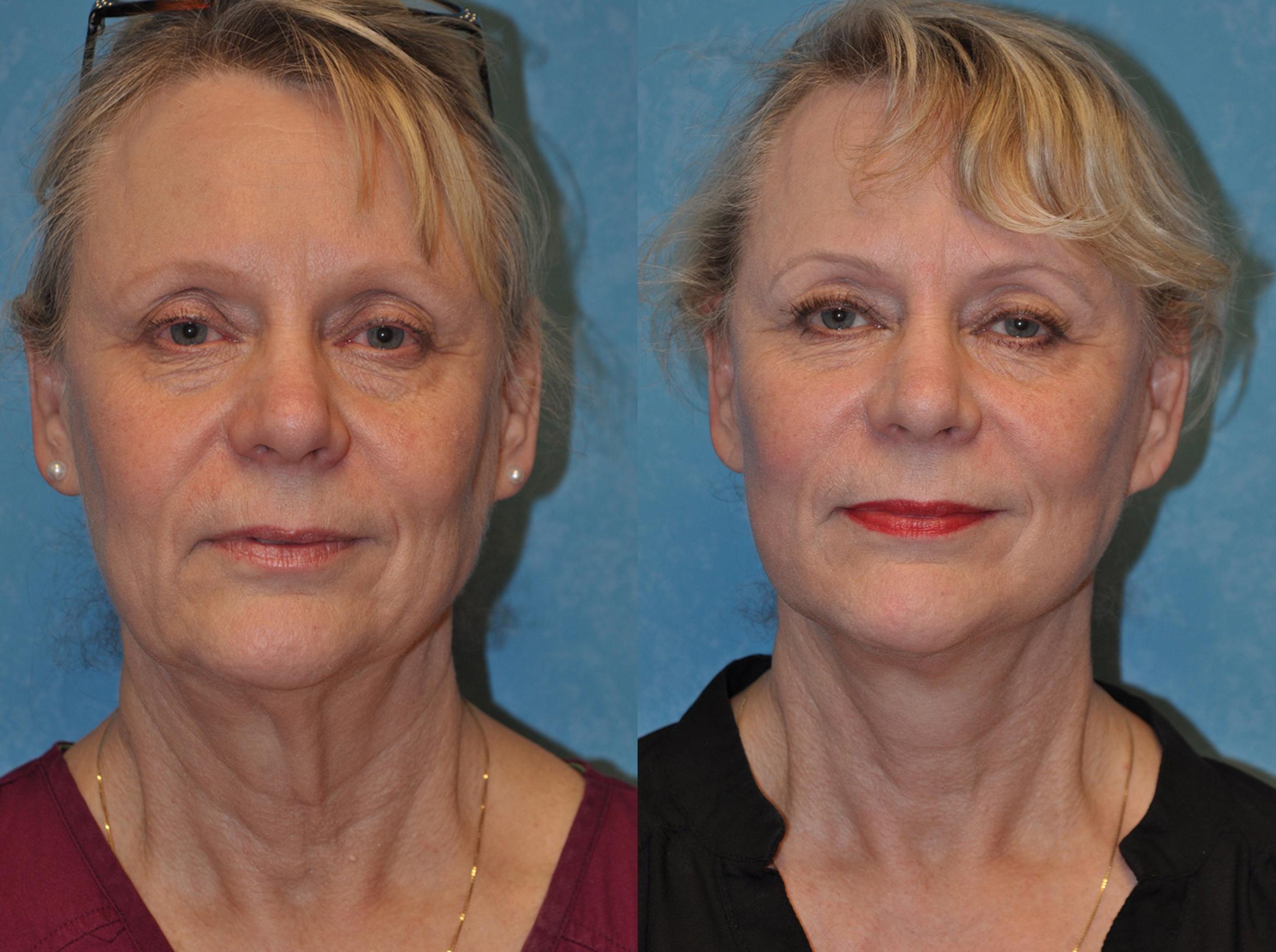 Face Lift Before & After Photo | Toledo, Ohio | Dr. Craig Colville