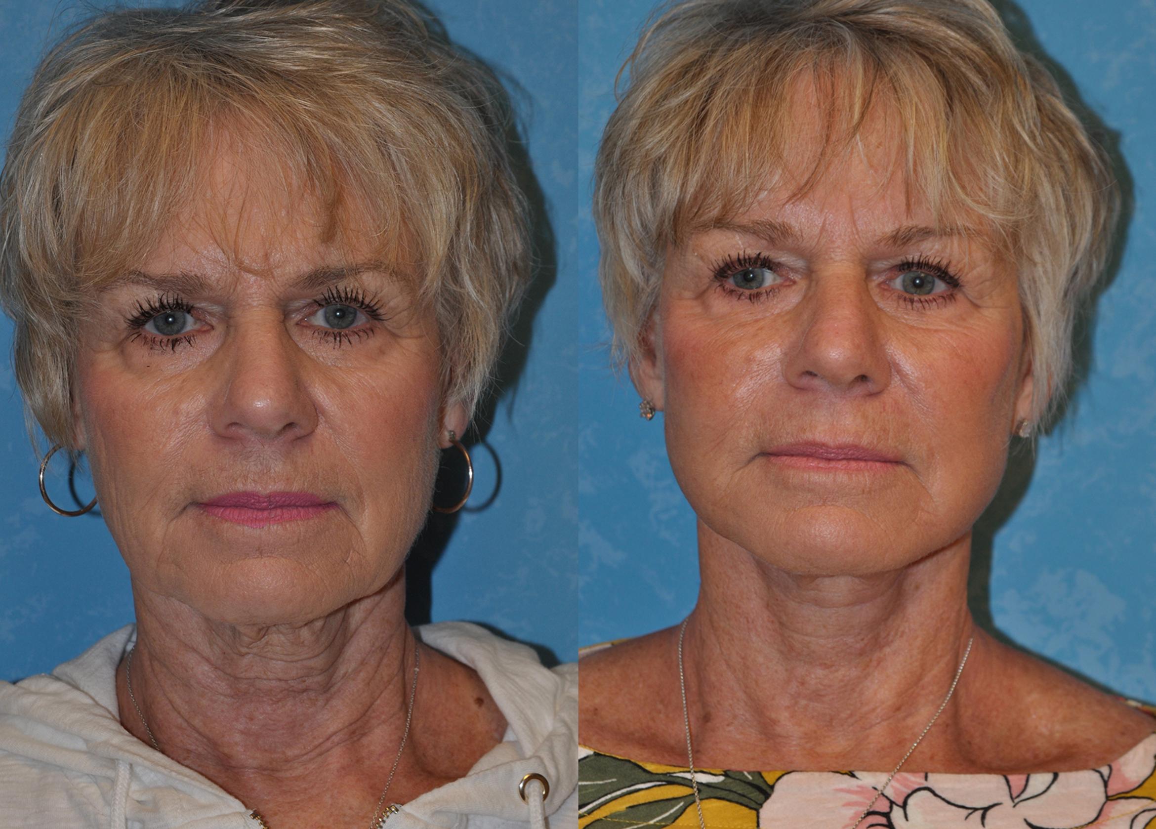 Face Lift Before & After Photo | Toledo, Ohio | Dr. Craig Colville