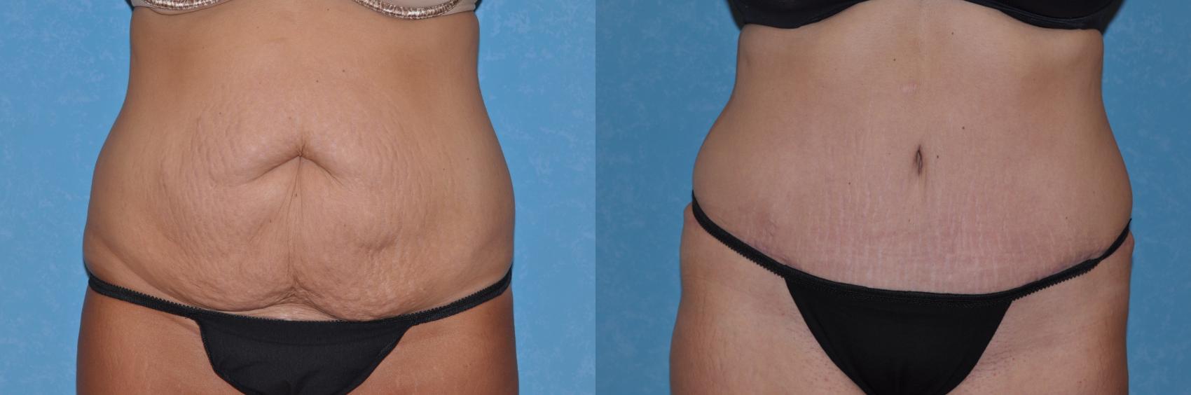 Before & After Abdominoplasty Case 102 Front View in Toledo, Ohio