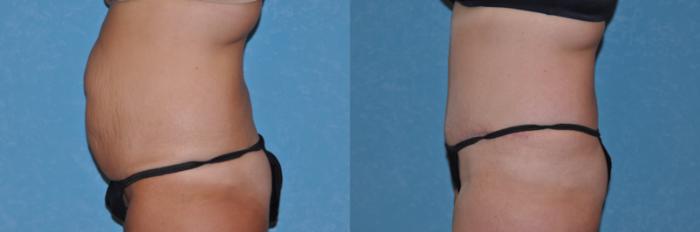 Before & After Abdominoplasty Case 102 Left Side View in Toledo, Ohio