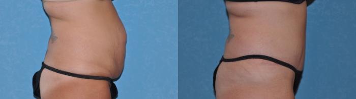 Before & After Abdominoplasty Case 102 Right Side View in Toledo, Ohio