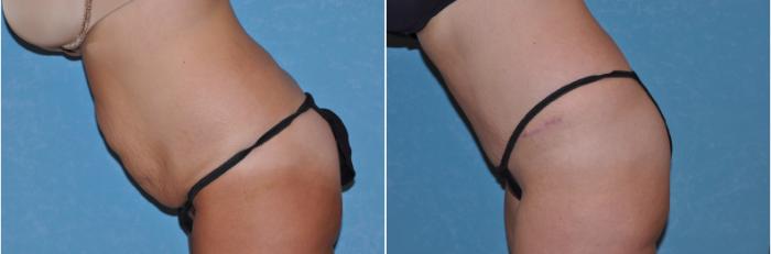 Before & After Abdominoplasty Case 102 View #1 View in Toledo, Ohio