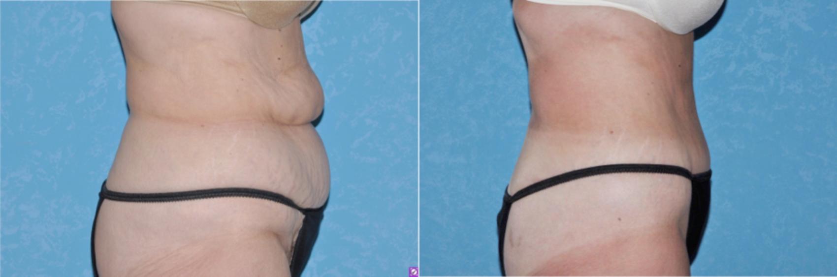 Before & After Abdominoplasty Case 117 View #1 View in Toledo, Ohio