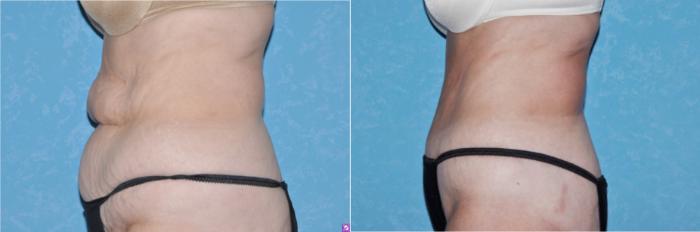 Before & After Abdominoplasty Case 117 View #2 View in Toledo, Ohio