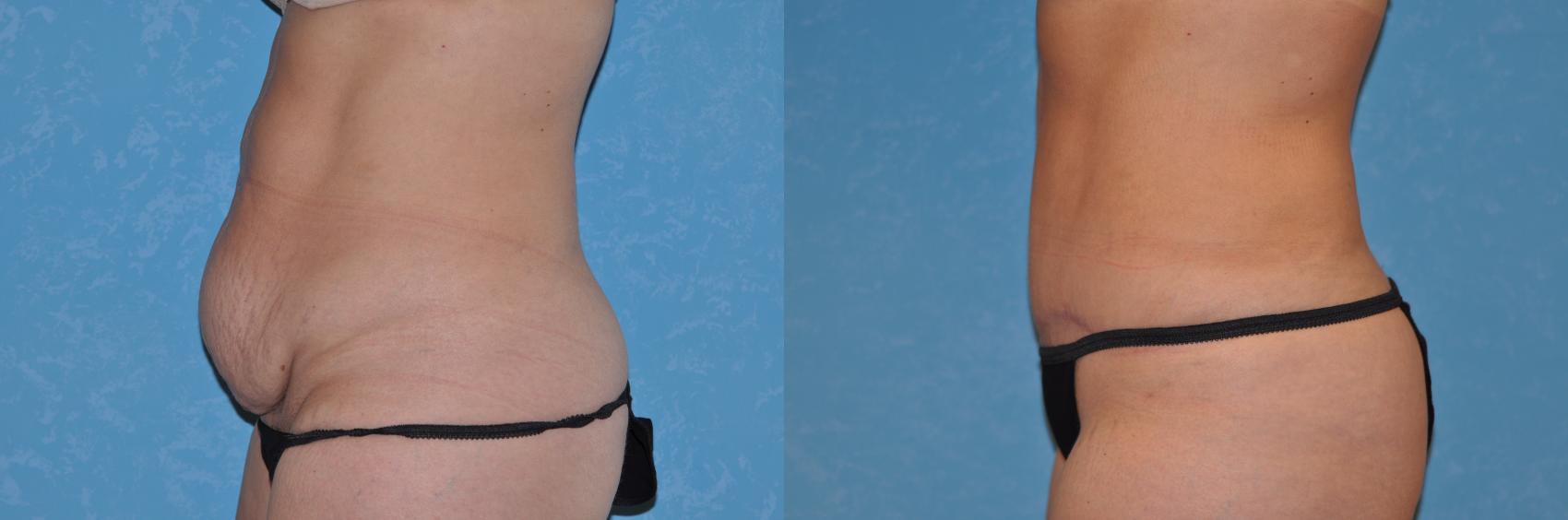 Before & After Abdominoplasty Case 123 View #1 View in Toledo, Ohio