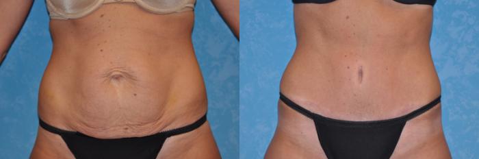Before & After Abdominoplasty Case 126 View #1 View in Toledo, Ohio
