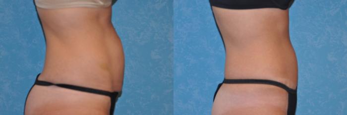 Before & After Abdominoplasty Case 126 View #3 View in Toledo, Ohio