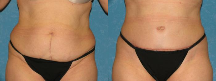 Before & After Abdominoplasty Case 157 View #1 View in Toledo, Ohio