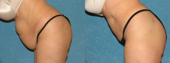 Before & After Abdominoplasty Case 157 View #2 View in Toledo, Ohio