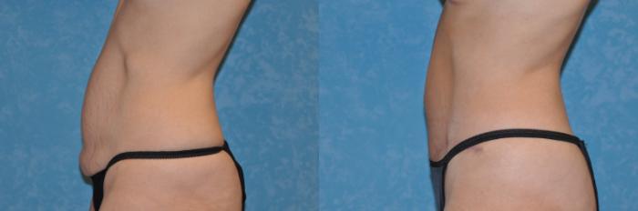 Before & After Abdominoplasty Case 164 View #1 View in Toledo, Ohio