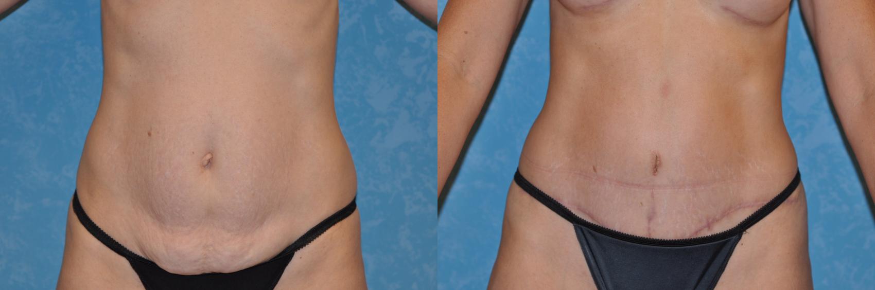 Before & After Abdominoplasty Case 164 View #2 View in Toledo, Ohio