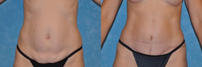 Before & After Abdominoplasty Case 164 View #2 View in Toledo, Ohio