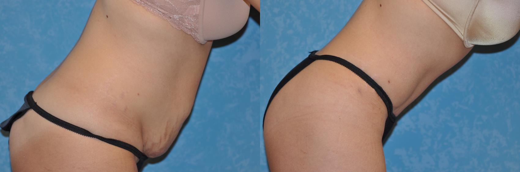 Before & After Abdominoplasty Case 165 View #3 View in Toledo, Ohio