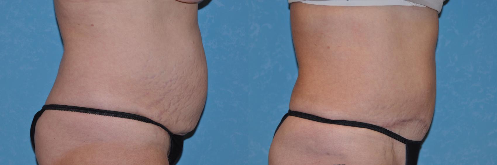 Before & After Abdominoplasty Case 167 View #1 View in Toledo, Ohio