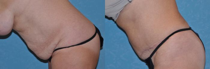 Before & After Abdominoplasty Case 167 View #2 View in Toledo, Ohio