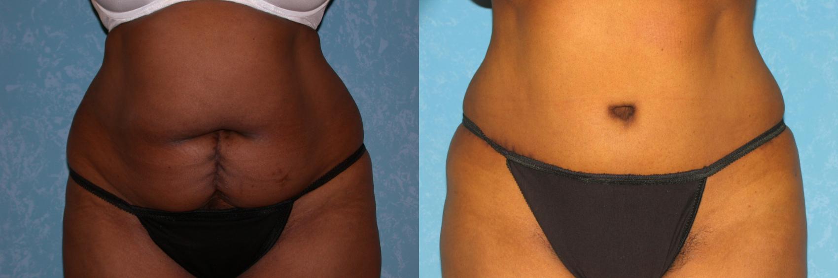 Before & After Abdominoplasty Case 170 View #1 View in Toledo, Ohio