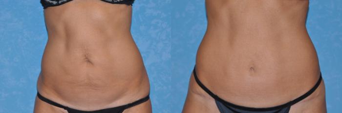 Before & After Abdominoplasty Case 171 View #1 View in Toledo, Ohio