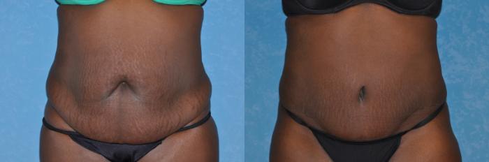 Before & After Abdominoplasty Case 197 View #1 View in Toledo, Ohio