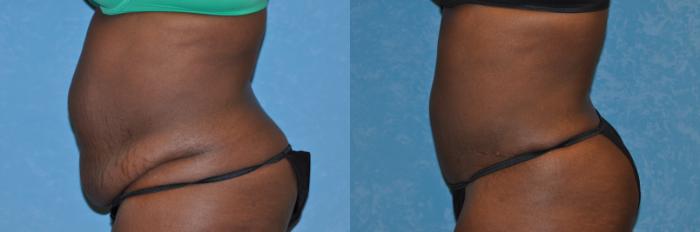 Before & After Abdominoplasty Case 197 View #2 View in Toledo, Ohio