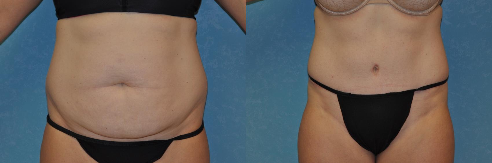 Before & After Abdominoplasty Case 237 View #1 View in Toledo, Ohio