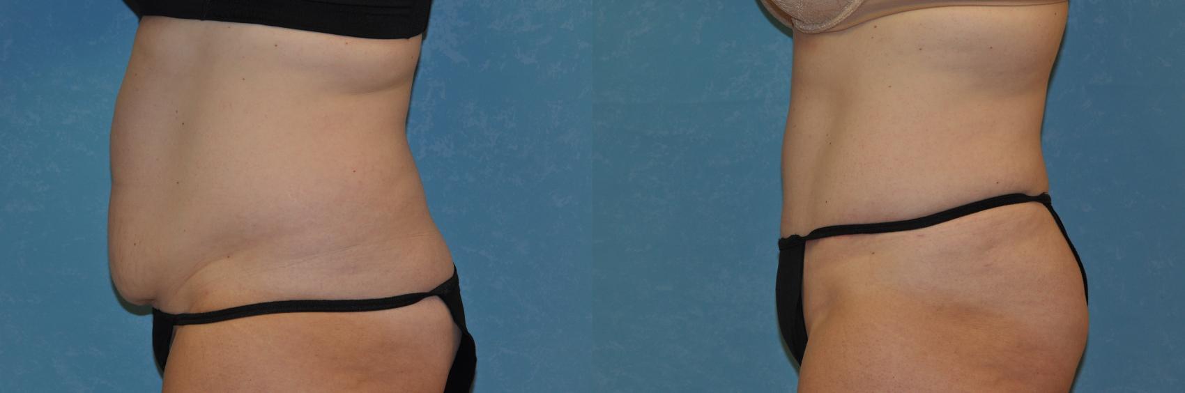 Before & After Abdominoplasty Case 237 View #2 View in Toledo, Ohio