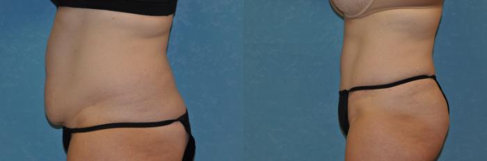 Before & After Abdominoplasty Case 237 View #2 View in Toledo, Ohio