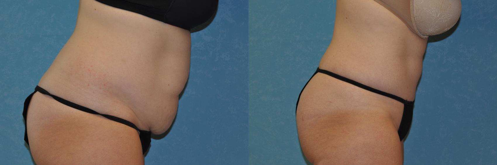 Before & After Abdominoplasty Case 237 View #3 View in Toledo, Ohio
