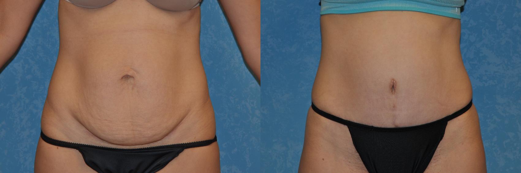 Before & After Abdominoplasty Case 238 View #1 View in Toledo, Ohio