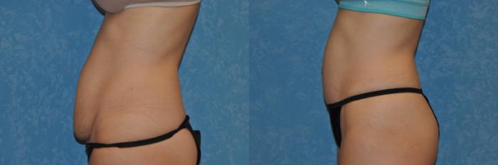 Before & After Abdominoplasty Case 238 View #2 View in Toledo, Ohio