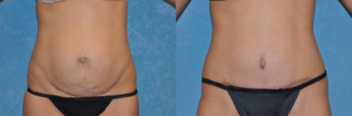 Before & After Abdominoplasty Case 241 View #1 View in Toledo, Ohio