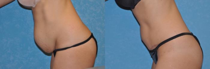 Before & After Abdominoplasty Case 241 View #2 View in Toledo, Ohio