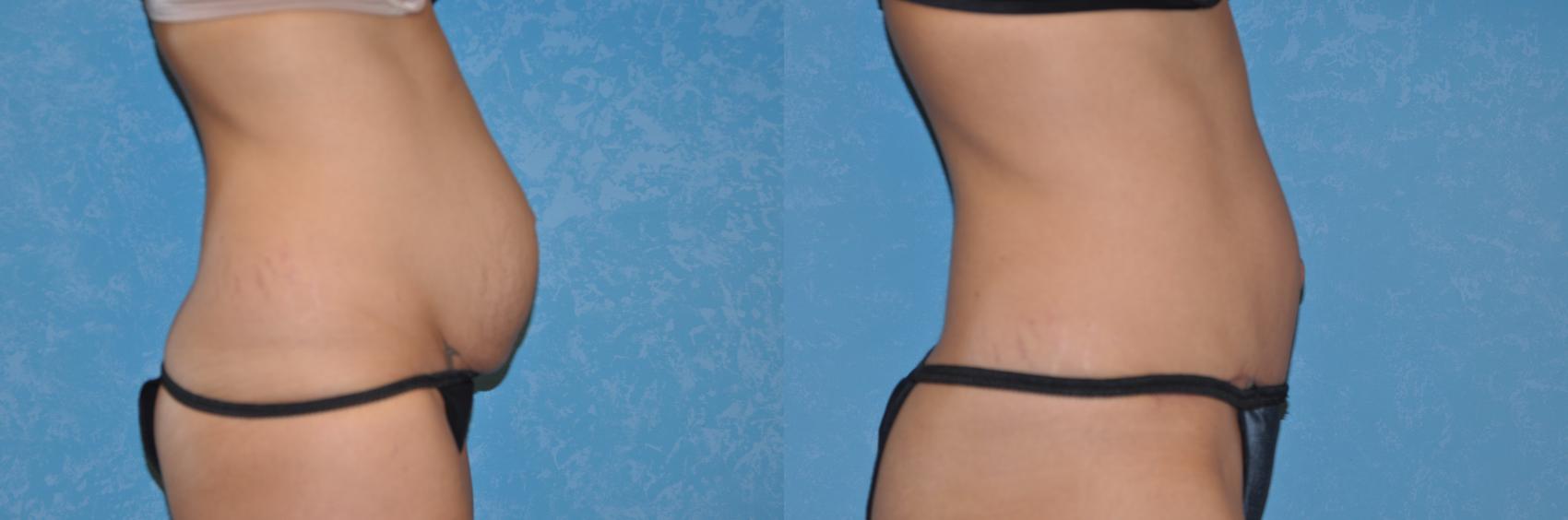 Before & After Abdominoplasty Case 241 View #3 View in Toledo, Ohio