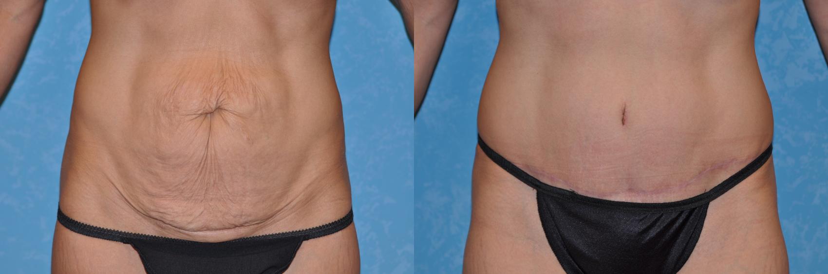 Before & After Abdominoplasty Case 243 View #1 View in Toledo, Ohio