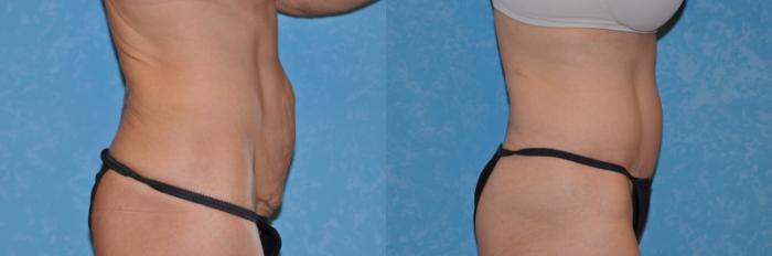Before & After Abdominoplasty Case 243 View #2 View in Toledo, Ohio