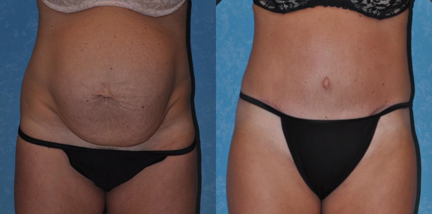 Before & After Abdominoplasty Case 276 View #1 View in Toledo, Ohio