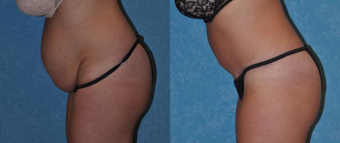 Before & After Abdominoplasty Case 276 View #2 View in Toledo, Ohio