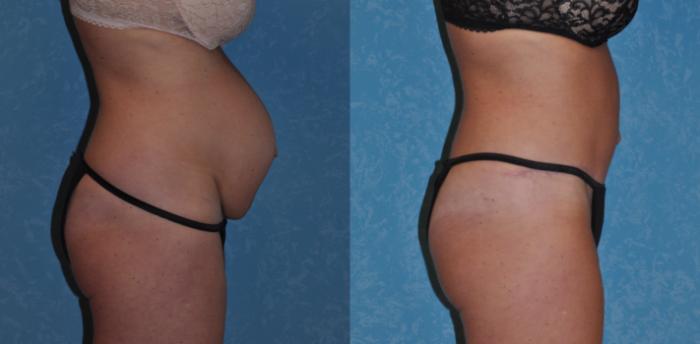 Before & After Abdominoplasty Case 276 View #3 View in Toledo, Ohio