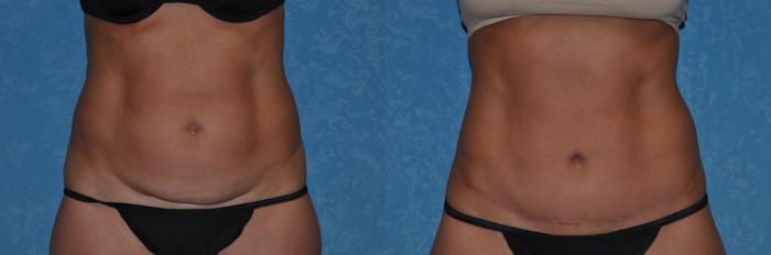 Before & After Abdominoplasty Case 279 View #1 View in Toledo, Ohio