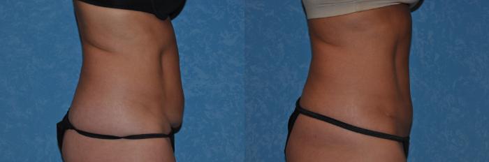 Before & After Abdominoplasty Case 279 View #2 View in Toledo, Ohio