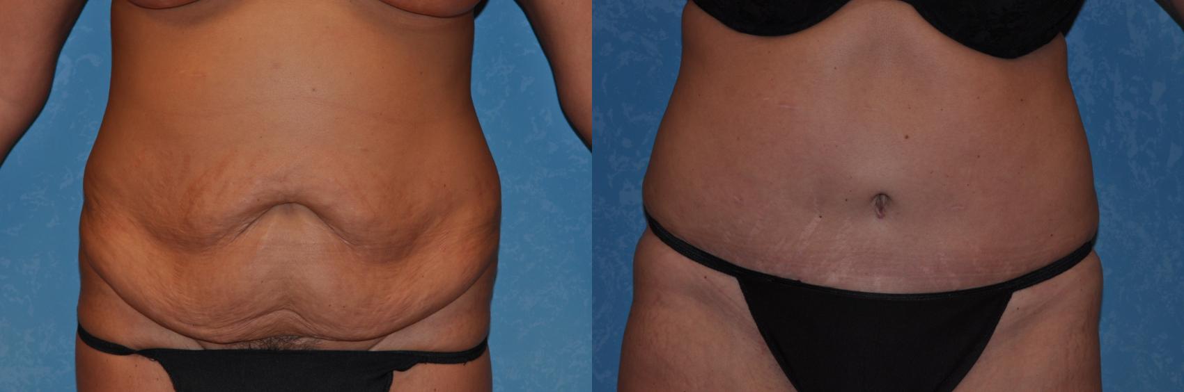 Before & After Abdominoplasty Case 281 View #1 View in Toledo, Ohio