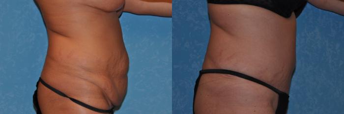 Before & After Abdominoplasty Case 281 View #2 View in Toledo, Ohio