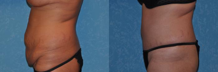 Before & After Abdominoplasty Case 281 View #3 View in Toledo, Ohio