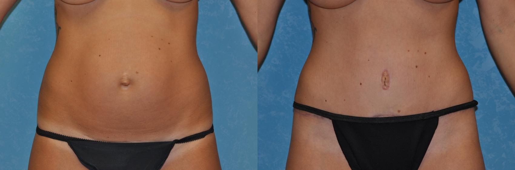 Before & After Abdominoplasty Case 289 View #1 View in Toledo, Ohio