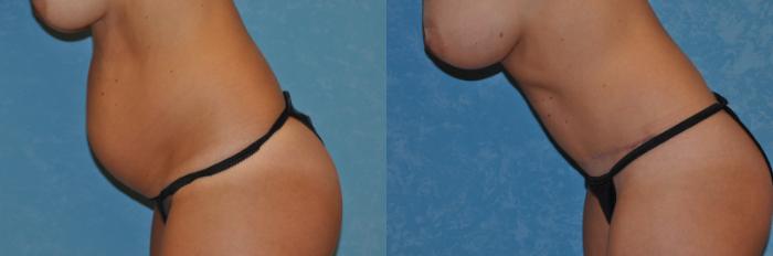 Before & After Abdominoplasty Case 289 View #2 View in Toledo, Ohio