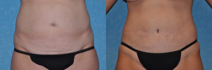 Before & After Abdominoplasty Case 290 View #1 View in Toledo, Ohio