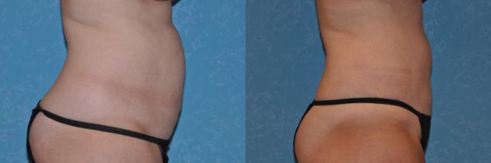 Before & After Abdominoplasty Case 290 View #2 View in Toledo, Ohio