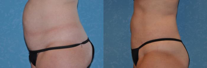 Before & After Abdominoplasty Case 290 View #3 View in Toledo, Ohio